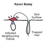 razor-bump-1