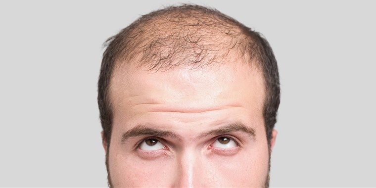 Going Bald? Fight Hair Loss With Effective Medicine 