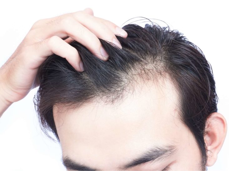 5 Signs That You Might Have Male Pattern Baldness