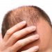 How Much Does Scalp Micropigmentation Cost?