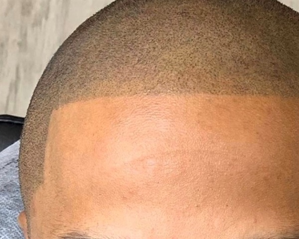 Scalp Micropigmentation After Care Tips
