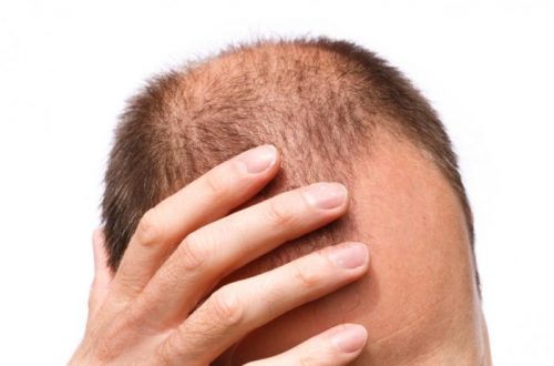 How Much Does Scalp Micropigmentation Cost?