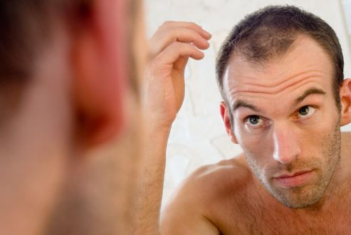 4 Things To Consider When Having A Hair Transplant