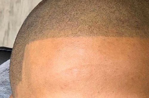 Scalp Micropigmentation After Care Tips